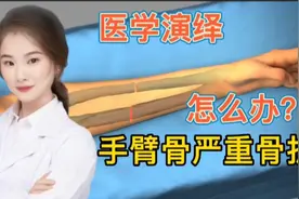 医学演绎 人体手臂骨头骨折骨裂 看医生如何进行治疗 手术固定视频封面