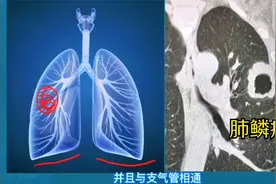 肺里发现空洞，CT片怎样区别肺癌和肺结核？3分钟学会1个要点视频封面