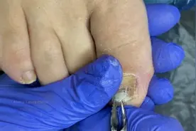 脚趾甲变厚变黄要警惕！这个女孩的脚趾甲里藏满真菌，要好好治疗