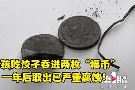 男孩吃饺子吞进两枚“福币” 一年后取出已严重腐蚀！视频封面