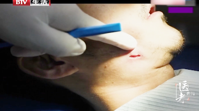 智齿伤口像烂了怎么办