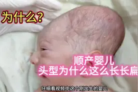 大揭秘 为什么顺产的新生儿大多数头型长长扁扁像“冬瓜”