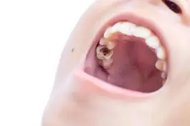 不疼的蛀牙需要治疗吗？医生：不可拖延，不疼的蛀牙更要早点补