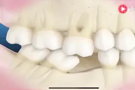 牙齿缺失长期不修补，会怎样？医生：可能会带来这3种不良影响！