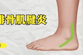 小腿外侧、脚踝外侧疼？三个动作，缓解腓骨肌腱炎视频封面