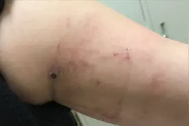贴膏药的地方痒得受不了，该怎么办？医生给了这些处理方法视频封面