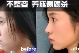 不整容！科学改善凸嘴下巴后缩 瘦双下巴 告别土气脸视频封面