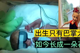 早产儿只有一个巴掌大，长得和外星人似的！出生就要面临死亡视频封面