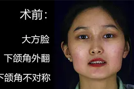 20多岁被当作“大妈”，花4w磨骨去掉大方脸，变瓜子脸大美女！