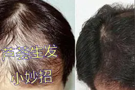 天天掉头发？2个芦荟生发小方法，坚持用让头发渐渐变浓密视频封面