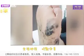 男子足底痣忽然扩散，大片发黑溃烂，紧急就医竟是恶性黑色素瘤视频封面