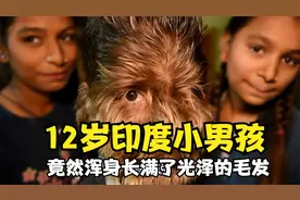 12岁印度男孩，竟然浑身长满了光泽亮丽的毛发，跟传说中狼人一样视频封面