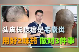 头皮上长疙瘩，那是毛囊炎！做对3件事，用好3味药，消炎好得快视频封面