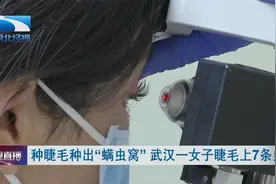 种睫毛种出“螨虫窝” 武汉一女子睫毛上7条虫视频封面