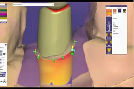种植基台怎么做？牙宝带你学习如何用EXOCAD软件设计基台