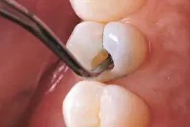 蛀牙真是因为虫子吗？3D动画模拟生长过程，网友：看着都疼