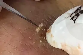 帅小伙脸上全是黑头，轻轻挤压就出来一片，看着太舒适解压了视频封面