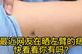 最近网友在晒左臂的痣，快看看为什么？