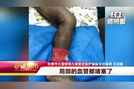 白山男童误踩毒蛇被咬，整条腿肿胀发黑，外科紧急手术|守望都市视频封面
