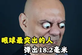 世界上眼球最突出的人，可弹出18.2毫米，每天的眼药水少不了视频封面