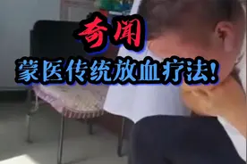 神秘“放血疗法”被称为千年藏医特色外疗法@中视频伙伴计划官号视频封面