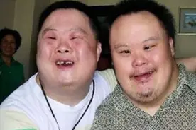 为什么唐氏综合征患者长的几乎都一模一样？今天总算明白了