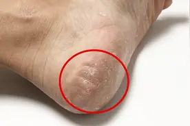 脚后跟干燥开裂不用怕，教你一土方法，简单好用又省钱视频封面