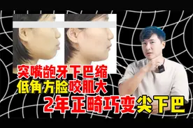 矫正如何分辨高角、低角面型？低角方脸就一定不能拔牙吗？视频封面