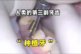 种植牙是用生物材料制成的仿生牙含种植体和承担咀嚼的牙冠两部分视频封面