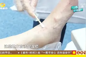 春季湿疹易发须防范：七旬老人脚踝起疹，挠破皮瘙痒仍不止视频封面