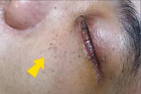 脸上长了这些东西，觉得影响美观，激光几分钟搞定！视频封面
