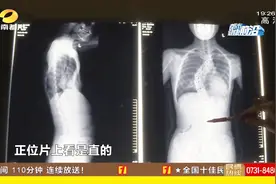 13岁女孩患漏斗胸，脊柱畸形呈“蛇形”，省人医实施超微创手术视频封面