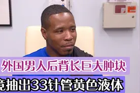外国黑人后背长巨大肿块，竟抽出33针管液体，重量达到一升视频封面