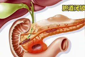 小儿胆道闭锁是什么病？家长注意：第2种证型情况糟糕！视频封面