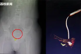 13岁少年尿道插10厘米针滑入膀胱近一年 取出已生锈视频封面