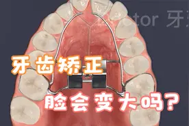 牙齿扩弓视频过程，不拔牙的正畸方法，牙齿矫正扩弓脸会变大吗？视频封面