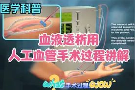 透析用人工血管内瘘手术过程详解（动画）视频封面