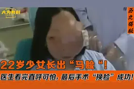 22岁少女因长“马脸“，13年蒙面不敢见人，最后手术“换脸”成功视频封面