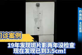门诊案例：19年发现斑片影两年没检查，现在发现已到3.5cm！视频封面