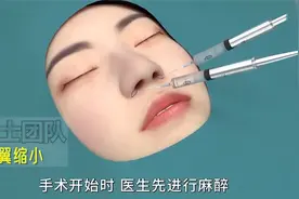 鼻翼缩小术视频封面