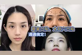 眼窝凹陷、太阳穴凹陷，脂肪填充存活率高吗？可以维持多久？