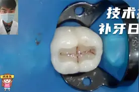 牙齿烂了补牙到底贵不贵，从两百到一千多，没有最贵只有更贵视频封面