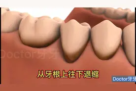 牙齿不好出血有牙结石，不要到治疗时才追悔莫及，定期洗牙更健康视频封面