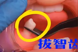 解压又治愈，拔智齿全过程，屏住呼吸慢慢看……视频封面