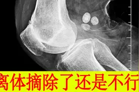 游离体膝关节镜摘除了，为什么膝关节又僵硬又站不住又蹲不下去视频封面