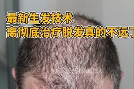 最新生发技术，离彻底治疗脱发真的不远了？视频封面