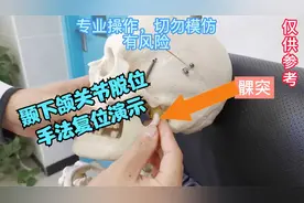 颞下颌关节为什么会脱位，如何复位，沈医生为你讲解，手法演示。