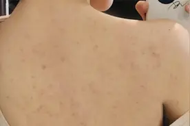 天生油皮爱长痘！后背反复瘙痒难耐有救了！过来人轻松一招就搞定视频封面