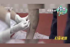 用针刺放血疗法，可以治疗静脉曲张？听听专家怎么说|职场健康课视频封面