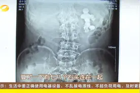 嗲嗲肚子酸胀医院检查发现肚里有“毛毛”，到底怎么回事儿？视频封面
